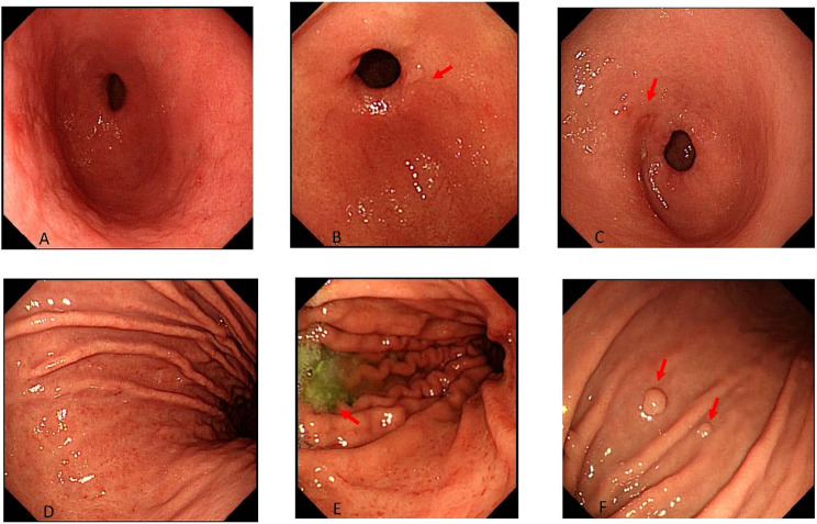 Prevalence of Helicobacter pylori infection in the general population in Wuzhou, China: a cross-sectional study.