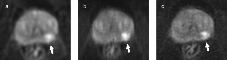 High-resolution Diffusion-weighted Imaging of the Prostate Using Multiplexed Sensitivity-encoding: Comparison with the Conventional and Reduced Field-of-view Techniques.