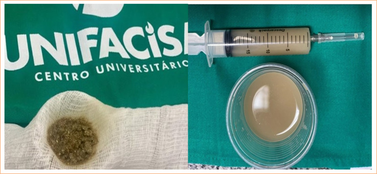 Intravenous meropenem and intraperitoneal use of 10% aqueous extract of Schinus terebinthifolius Raddi (Anacardiaceae) in elderly rats after induction of autogenous fecal peritonitis.