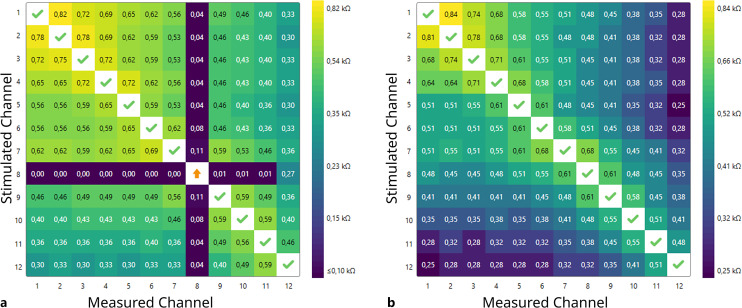 Voltage Matrix Algorithm for Intraoperative Detection of Cochlear Implant Electrode Misplacement.