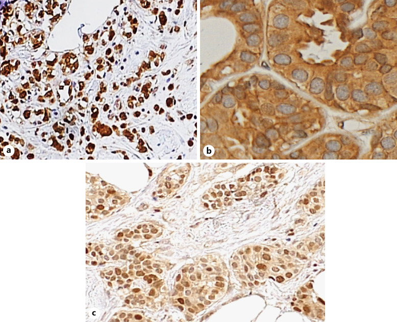 Prognostic and Clinical Significance of the Proliferation Marker MCM7 in Breast Cancer.