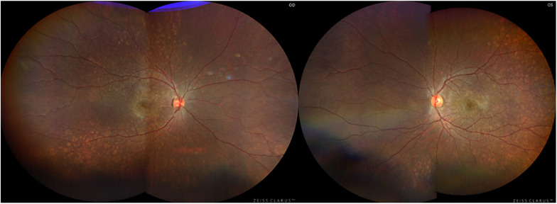 An Unusual Retinal Presentation of a Novel <i>COL11A1</i> Mutation: A Case Report.