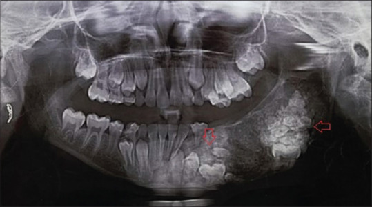 Anomalous Jaw Tumour Progression from Multiple Complex Odontomas to Cemento-ossifying Fibroma - A Case Report.