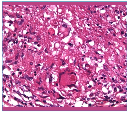 Paracoccidioidomycosis of the testis.