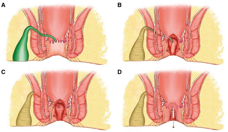 Preliminary results of a novel sphincter-sparing technique-fistula occlusion with the internal sphincter flap (FOISF)-for high complex anal fistulas.