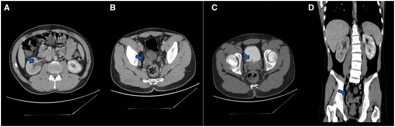 Unusual presentation of <i>Ascaris lumbricoides</i> in the urinary tract: a case report.