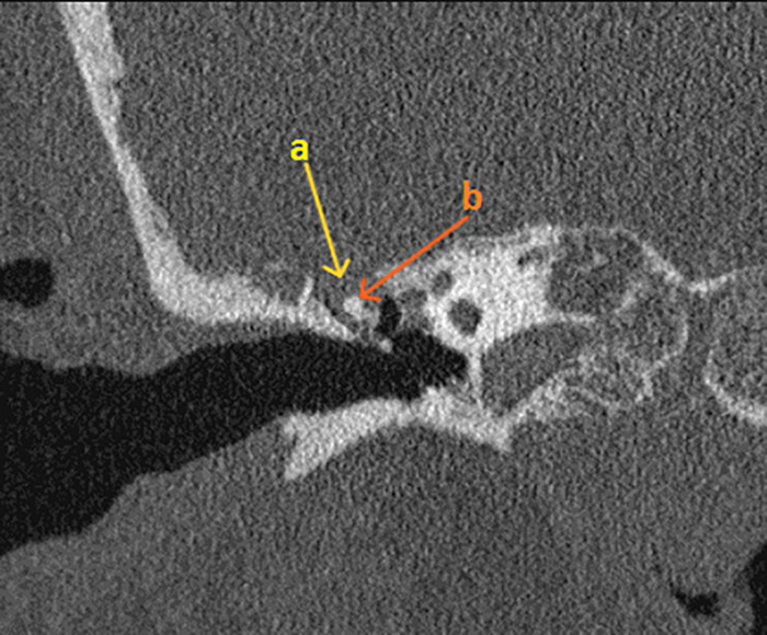 Cerebrospinal fluid leak-associated ventriculitis - a case report.