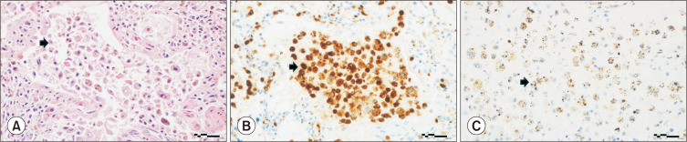 Histological Findings of ETosis in Hermansky-Pudlak Syndrome with Pulmonary Fibrosis: A Follow-Up Case Report.