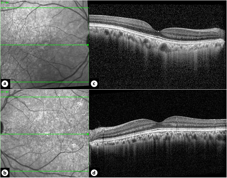 An Unusual Retinal Presentation of a Novel <i>COL11A1</i> Mutation: A Case Report.
