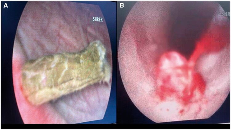 Unusual presentation of <i>Ascaris lumbricoides</i> in the urinary tract: a case report.