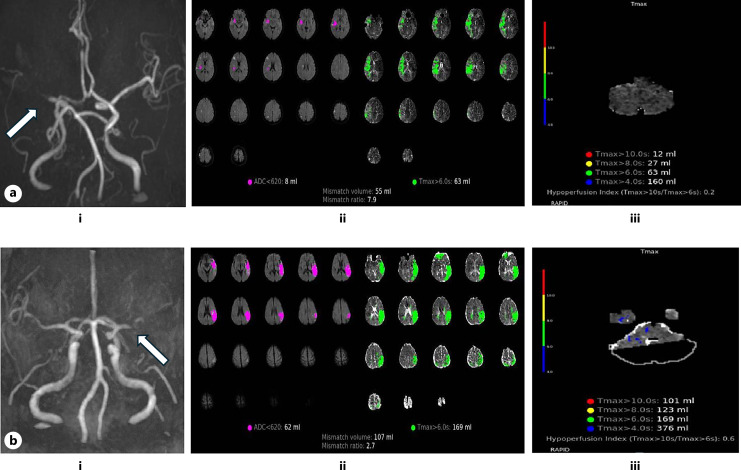 Safety and Efficacy of Thrombectomy in Vietnamese Stroke Patients Selected through Perfusion Imaging with an Onset Time between 6 and 24 Hours.