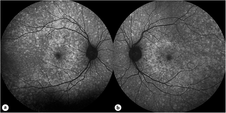 An Unusual Retinal Presentation of a Novel <i>COL11A1</i> Mutation: A Case Report.