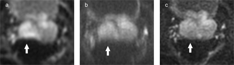 High-resolution Diffusion-weighted Imaging of the Prostate Using Multiplexed Sensitivity-encoding: Comparison with the Conventional and Reduced Field-of-view Techniques.