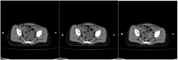 Early Manifestation of McCune-Albright Syndrome in a 32-Month-Old Female: A Rare Case Report.