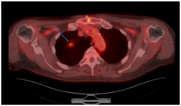 MALToma with a 'B'-Not for Benign, but for Bronchus-Associated: A Rare Case of Bronchus-Associated Lymphoid Tissue Lymphoma.