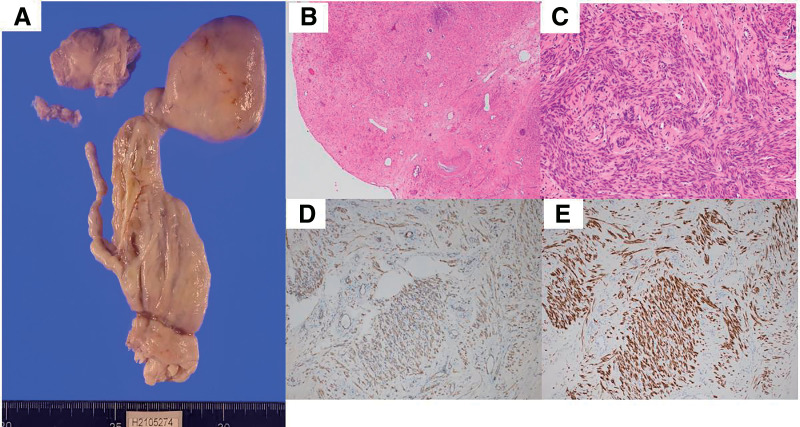 Surgical Strategy of Intravenous Leiomyomatosis with Intracardiac Extension: A Case Report.
