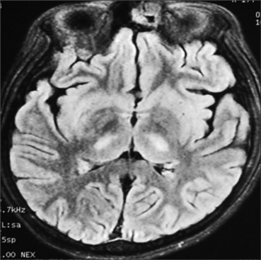 Role of therapeutic plasma exchange in dengue-related microangiopathy.