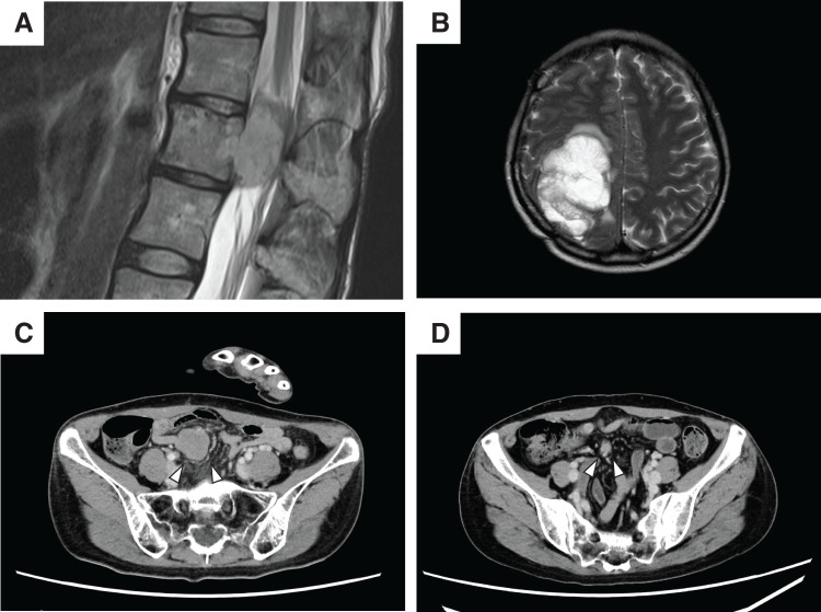 Curatively Resected Mesenteric Lymph Node Recurrence of Ewing Sarcoma.