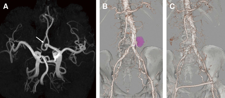 Acute Inflammatory Pseudoaneurysm of the Gastroepiploic Artery in a Patient with Multiple Aneurysms: A Case Highlighting Systemic Vascular Remodeling.