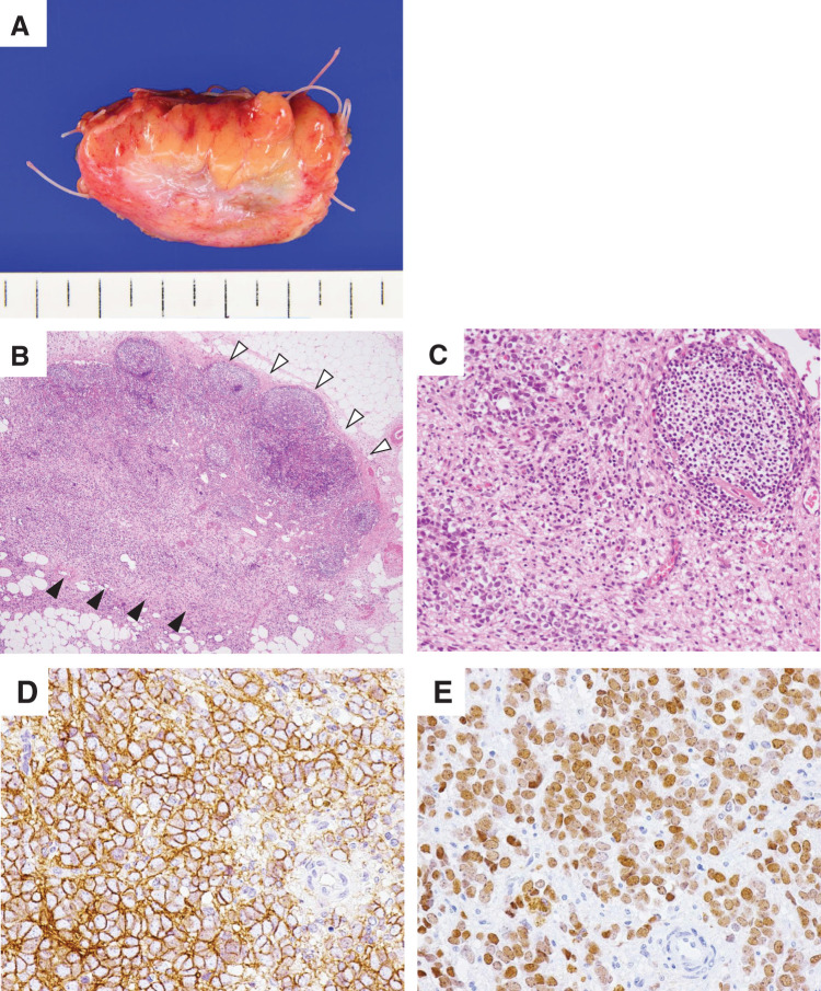 Curatively Resected Mesenteric Lymph Node Recurrence of Ewing Sarcoma.