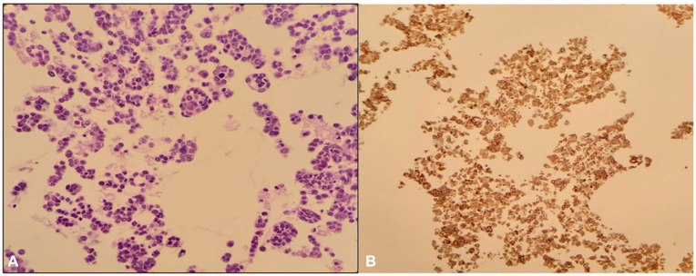 Cardiac Tamponade as the Initial Presentation of Squamous Cell Carcinoma of the Lung: A Case Report and Literature Review.