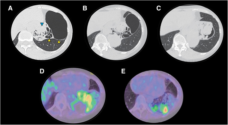 Delayed Diagnosis of Primary Pulmonary Sarcoma Arising from a Pulmonary Cyst in an Adult: A Case Report.