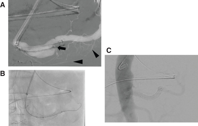 Hybrid Approach for Multiple Visceral Aneurysms with Isolated Dissection at the Superior Mesenteric Artery: A Case Report.