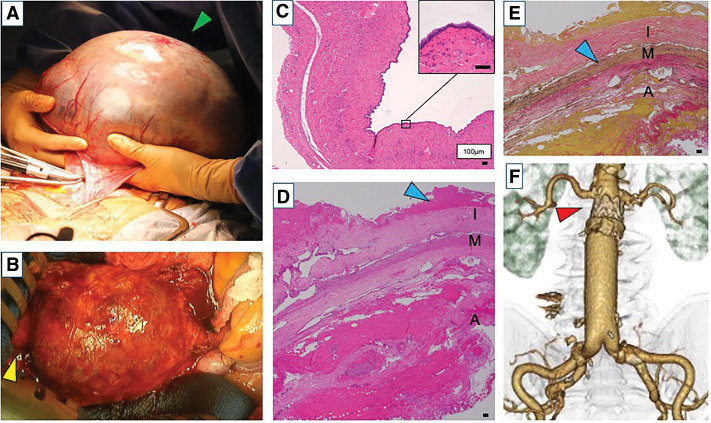 Late Open Conversion with Graft Replacement after Endovascular Aortic Repair along with Removal of a Giant Ovarian Tumor: A Case Report.