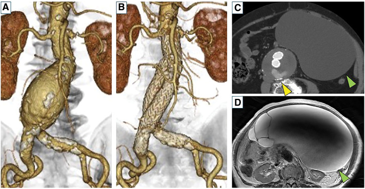 Late Open Conversion with Graft Replacement after Endovascular Aortic Repair along with Removal of a Giant Ovarian Tumor: A Case Report.