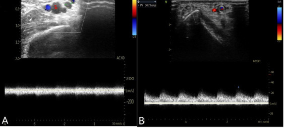 The thrill is vanished: Percutaneous exclusion of post trans radial arteriovenous fistula using stent graft through transbrachial approach.