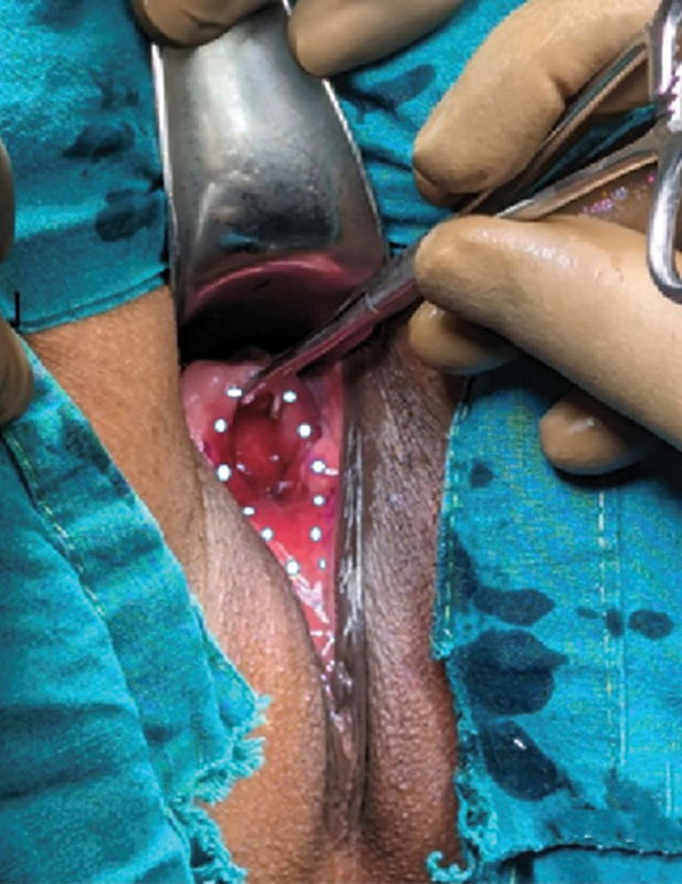 Use of Dermal Regeneration Template in Closure of a Large Vesicovaginal Fistula: An Initial Report.