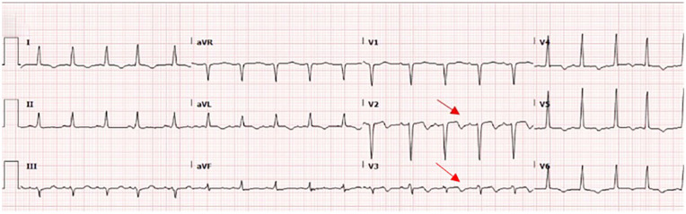 When the ECG Deceives: A Case of Pseudo-Wellens' Syndrome in the Setting of Stress-Induced Cardiomyopathy.