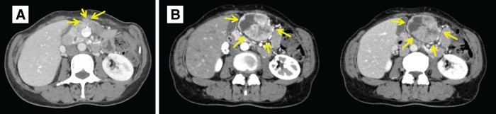 A Case of Gastric Neuroendocrine Carcinoma with Disseminated Recurrence 14 Years after Initial Surgery.