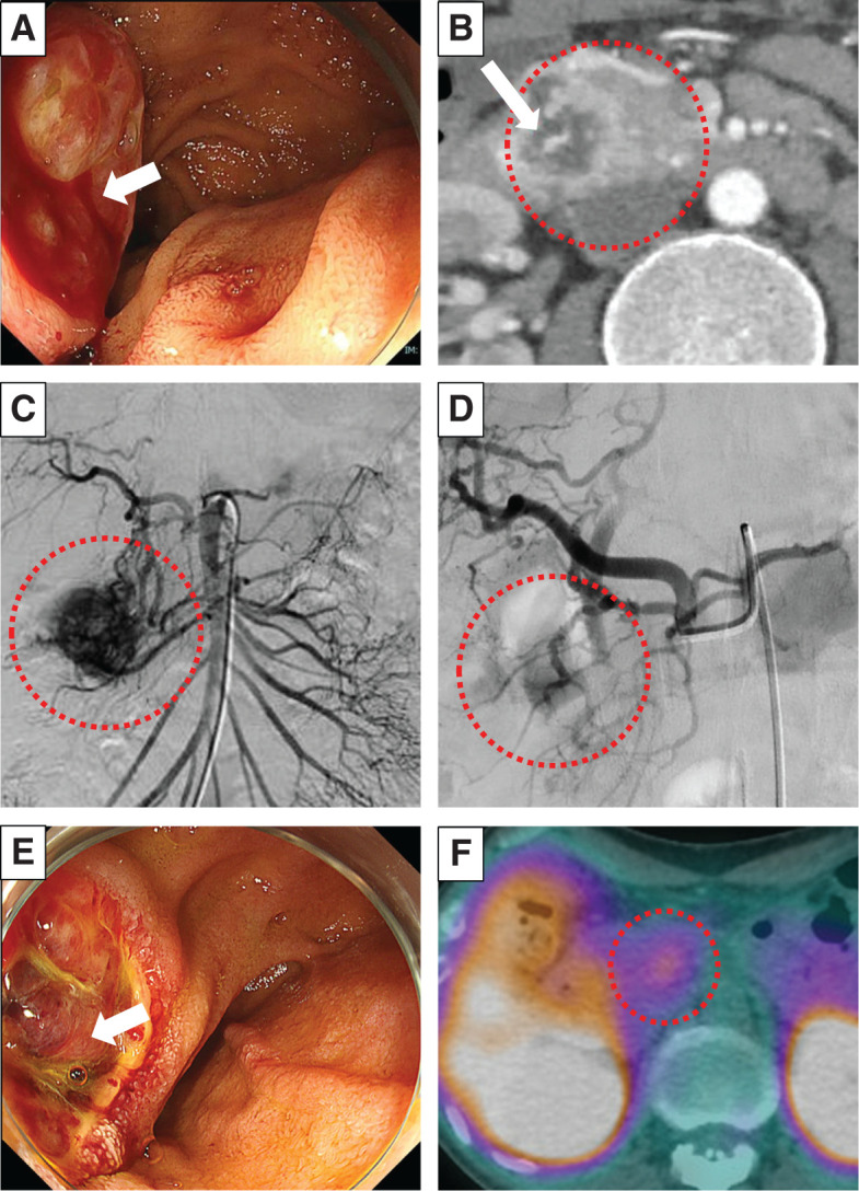 Pancreatic Hemangioblastoma in a Patient with von Hippel-Lindau Disease: A Case Report.