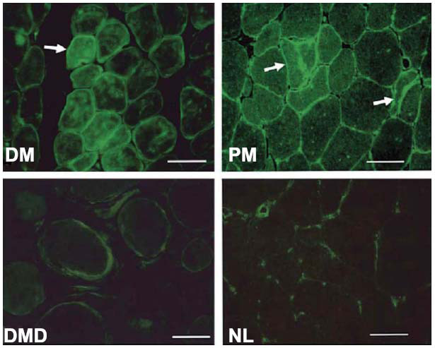 Inflammatory Myopathies and Autoimmune Gluten-related Disorders: A Scoping Review of Pathophysiological Interconnections and Hypothesis.