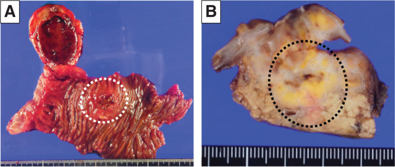Pancreatic Hemangioblastoma in a Patient with von Hippel-Lindau Disease: A Case Report.