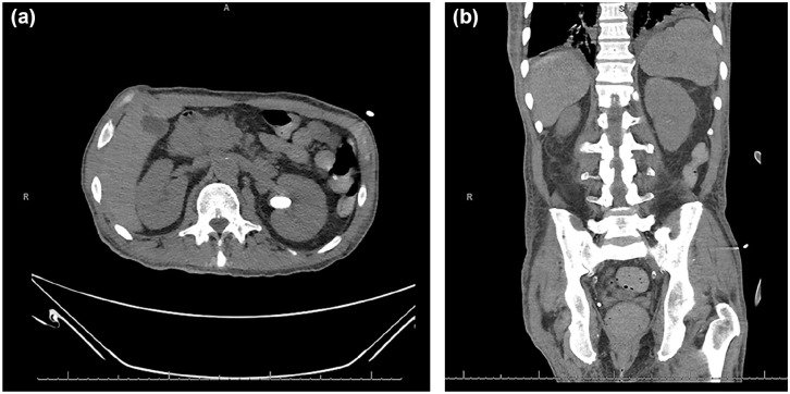 New Sarcoidosis Diagnosis Following Unresponsive Event During Hemodialysis.