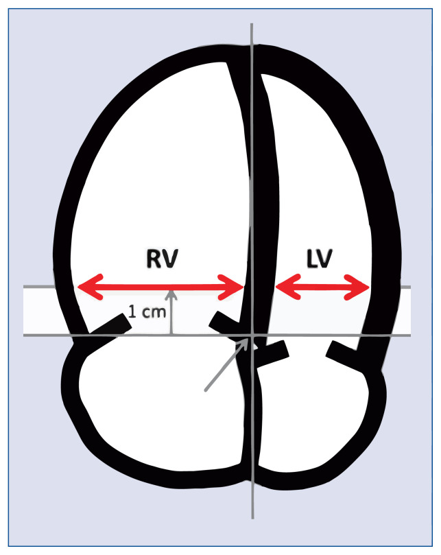 Aspiration thrombectomy compared to catheter directed thrombolysis in pulmonary embolism: Outcomes from a tertiary referral center.