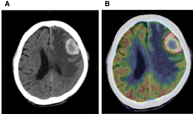 Postoperative Solitary Brain Metastasis from Residual Gastric Cancer: A Rare Case Report.