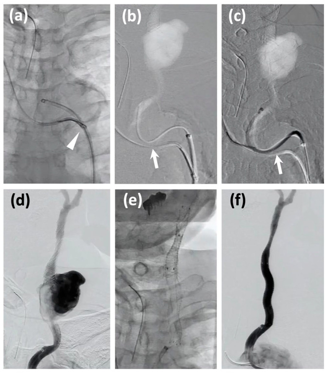 Carotid blowout syndrome as a late complication of carotid stenting in irradiated neck: covered stent treatment using the "No-Touch" technique.