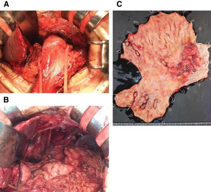 Postoperative Solitary Brain Metastasis from Residual Gastric Cancer: A Rare Case Report.