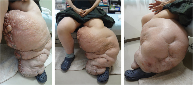 Massive Lymphedema in the Calf Complicated by Severe Skin Fibrosclerosis.