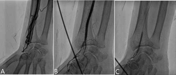 The thrill is vanished: Percutaneous exclusion of post trans radial arteriovenous fistula using stent graft through transbrachial approach.