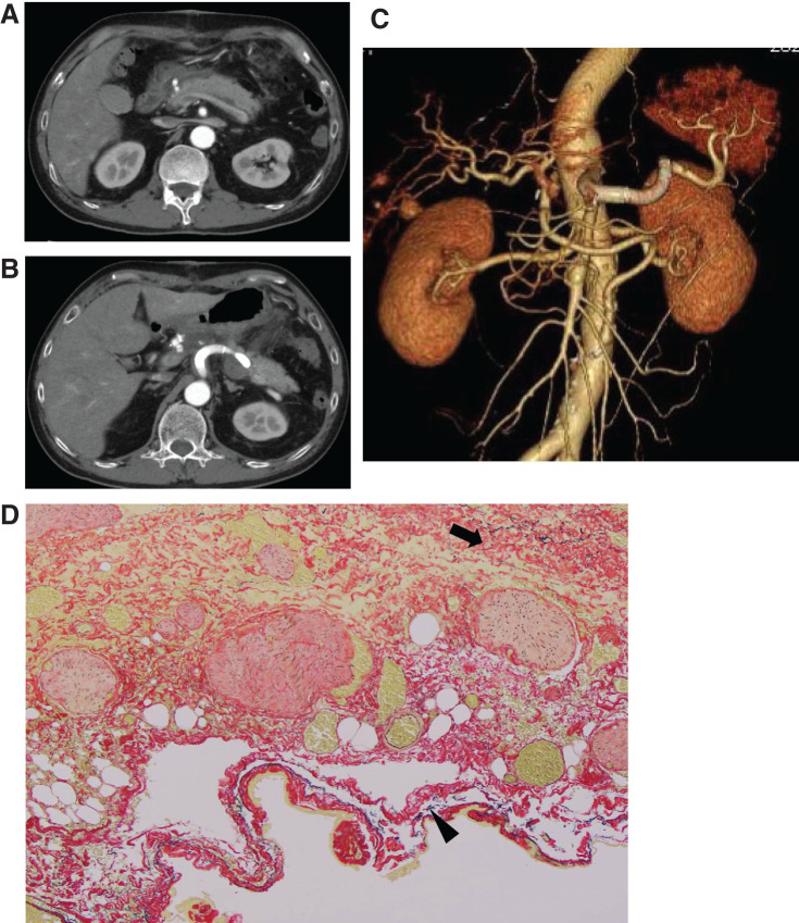 Hybrid Approach for Multiple Visceral Aneurysms with Isolated Dissection at the Superior Mesenteric Artery: A Case Report.