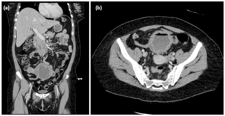 Endometriosis Presenting as a Malignant Appearing Cecal Mass.