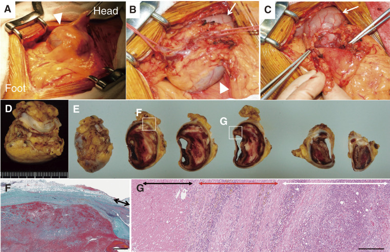 Acute Inflammatory Pseudoaneurysm of the Gastroepiploic Artery in a Patient with Multiple Aneurysms: A Case Highlighting Systemic Vascular Remodeling.