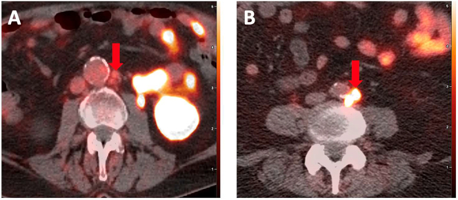 The potential of generative AI with prostate-specific membrane antigen (PSMA) PET/CT: challenges and future directions.
