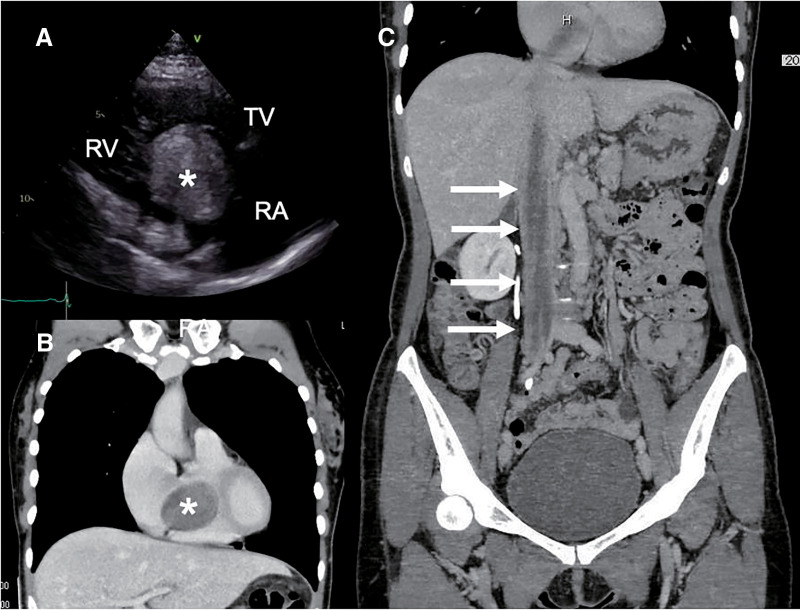 Surgical Strategy of Intravenous Leiomyomatosis with Intracardiac Extension: A Case Report.