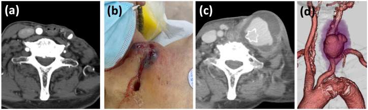 Carotid blowout syndrome as a late complication of carotid stenting in irradiated neck: covered stent treatment using the "No-Touch" technique.