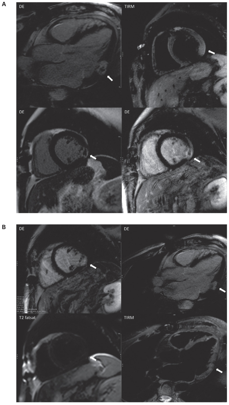 CMR-defined transmural myocardial infarction with area of microvascular obstruction in the MINOCA patient: How many undiagnosed cases are there?